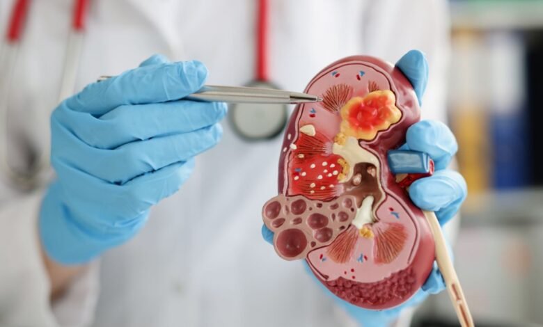 Cálculo renal causas sintomas danielhampl.com.br