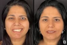 Projeto Social para Pacientes com Paralisia Facial Retorna com Apoio da Copaderma